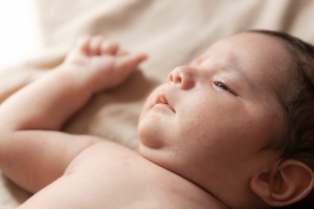 eczéma atopique bébé soigner-baby journal