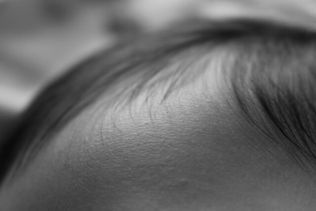plagiocéphalie bébé casque-Baby journal